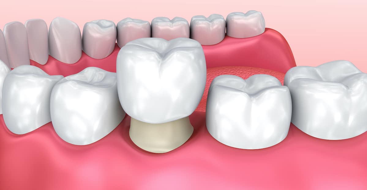 what is a dental crown