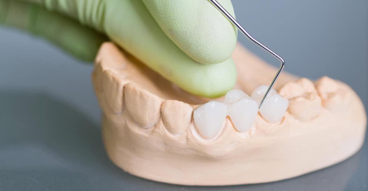 types of dental bridges