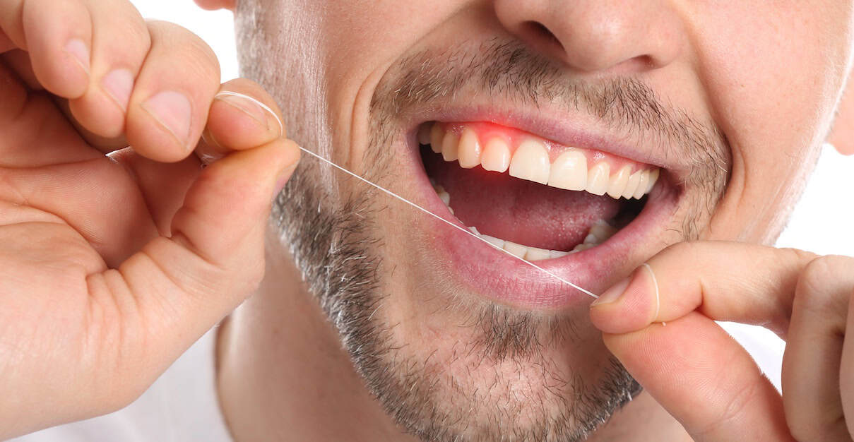 Gums bleed when flossing
