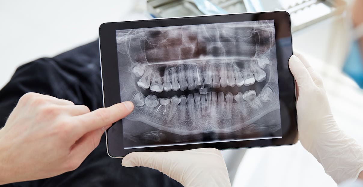 Are Dental X-Rays Safe