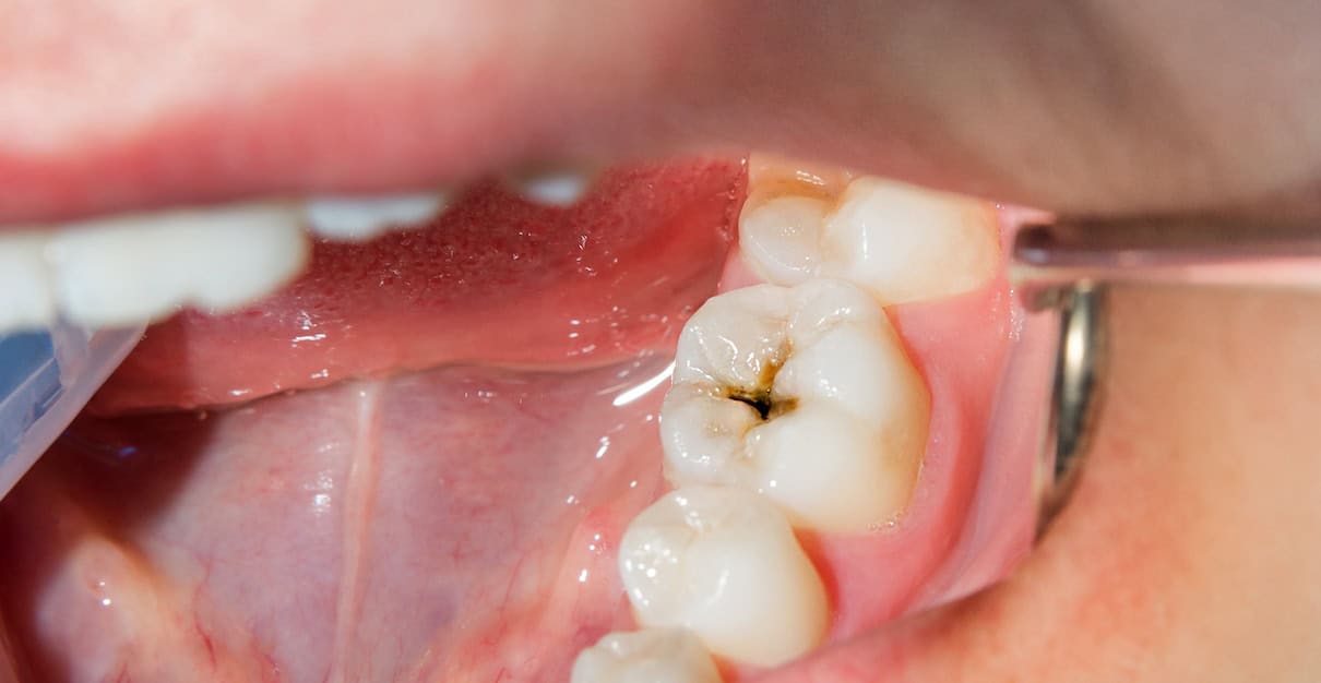 Prevent Future Cavities