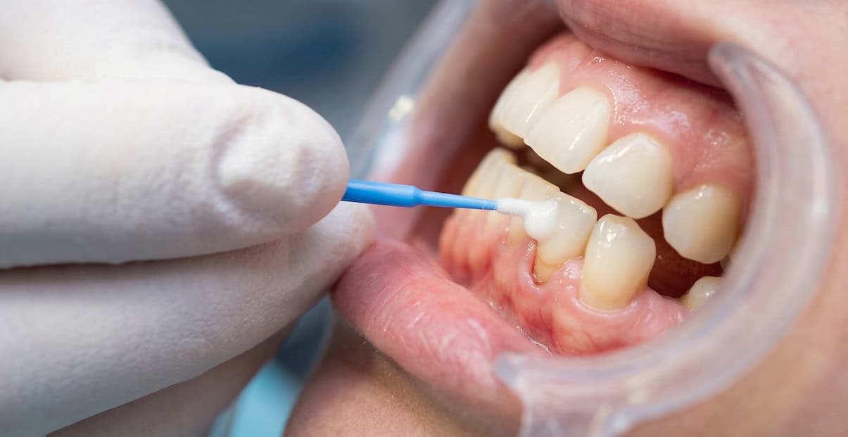 Do I need fluoride