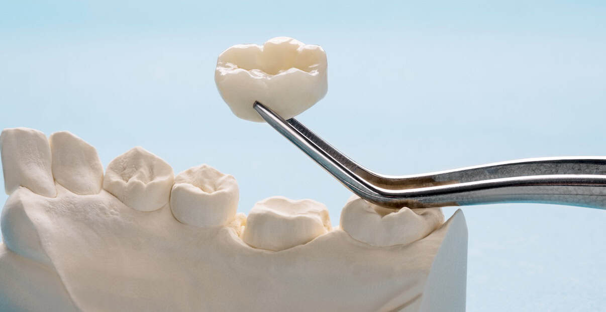 crown vs fillings