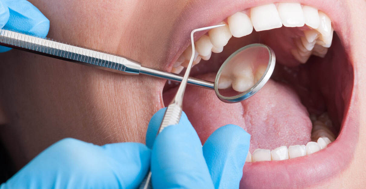 Cavity without pain
