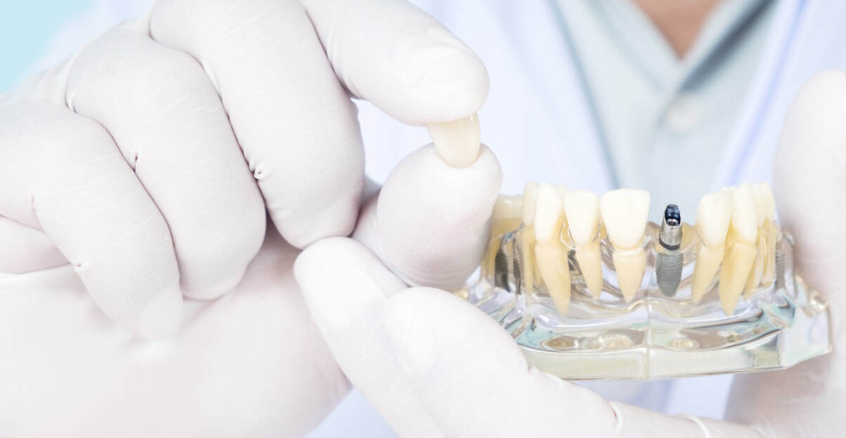 Dental implants Charlotte NC